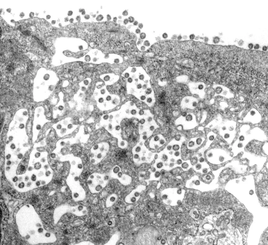 Electron micrographs Coronaviruses infecting a cell