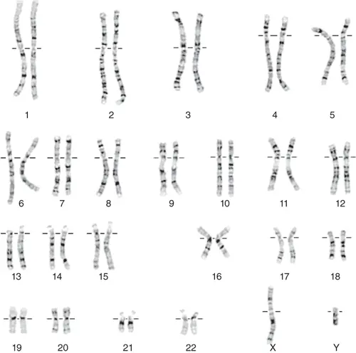 G-banding-Karyotype-hunam-chromosome