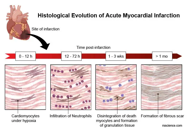 progress-myocardial-infarction-heart-attack