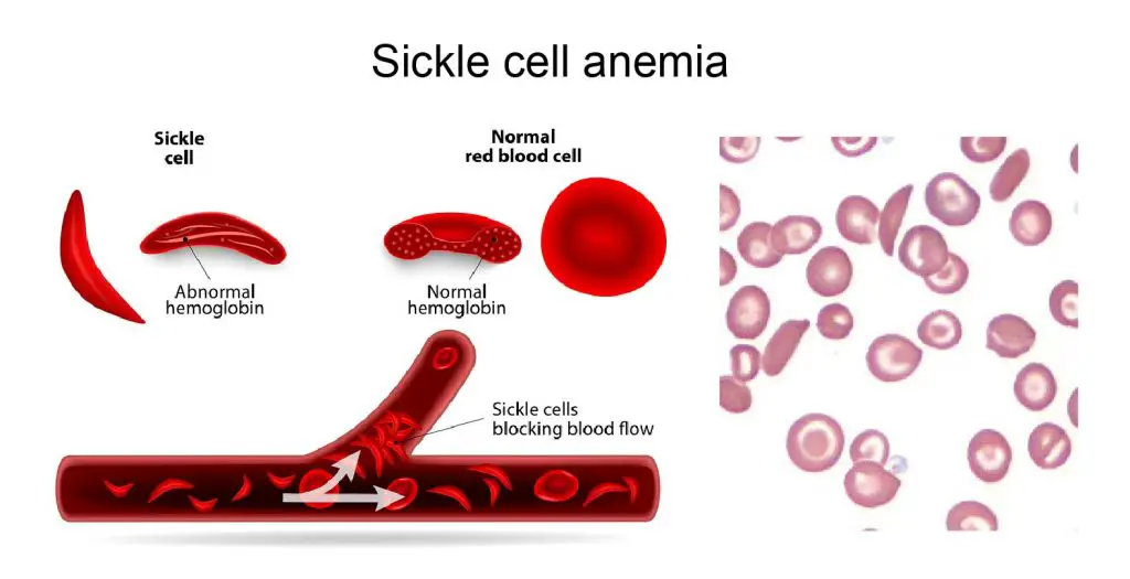 Sickle-cell-anemia