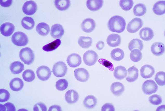 blood smear Plasmodium falciparum infection
