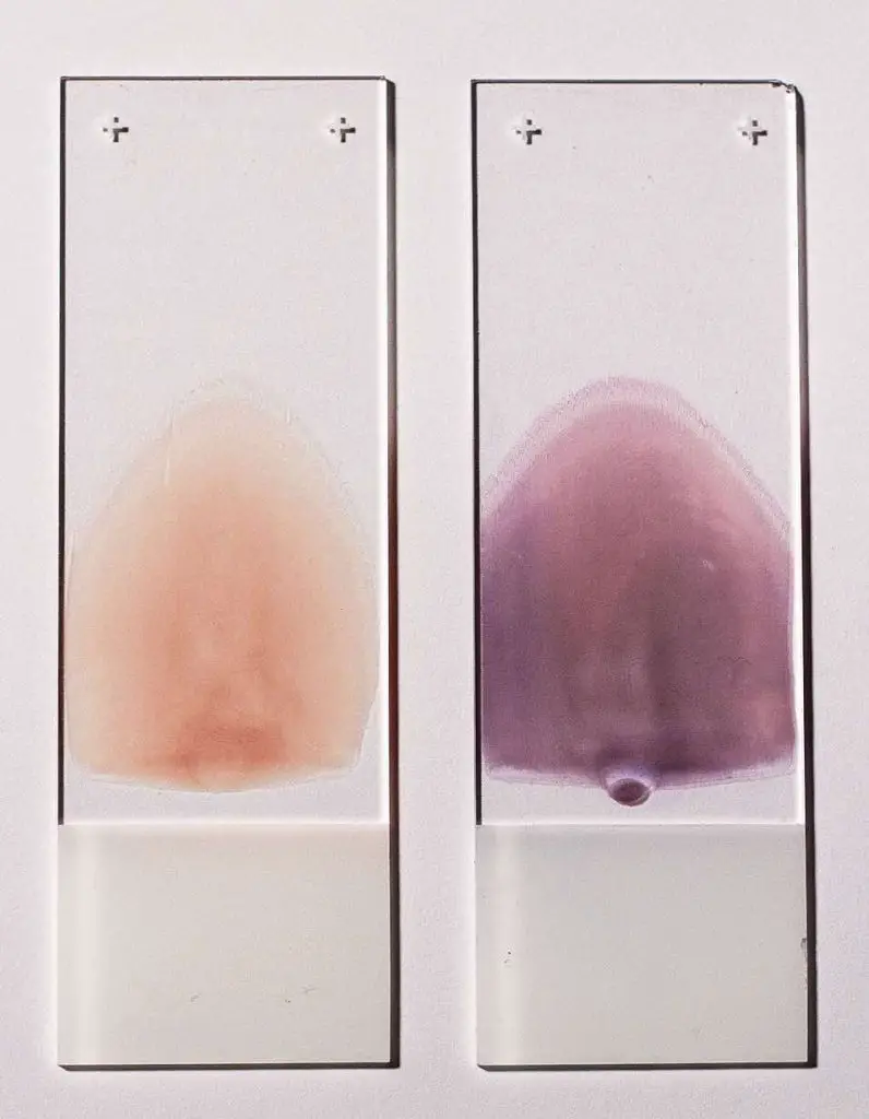 blood-smear-stained-and-unstained
