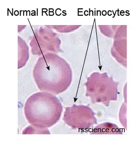 echinocytes