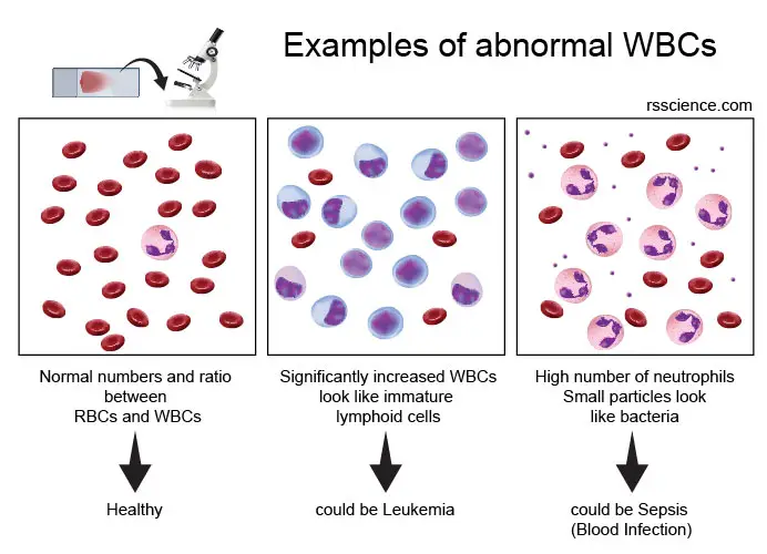 examples-of-abnormal-WBC