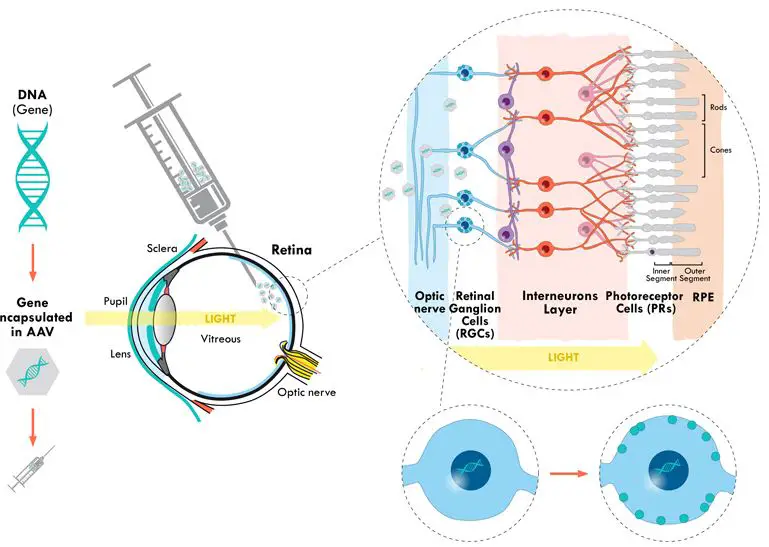 gensight-gene-therapy-blindness-ophtalmology